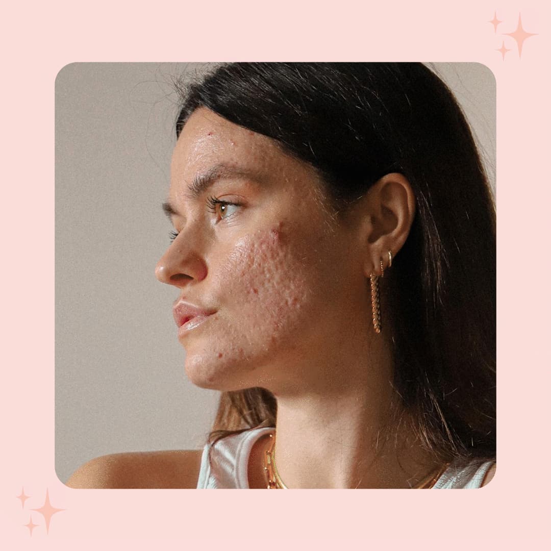 Skin Positivity | Tudo sobre o movimento de aceitação da pele