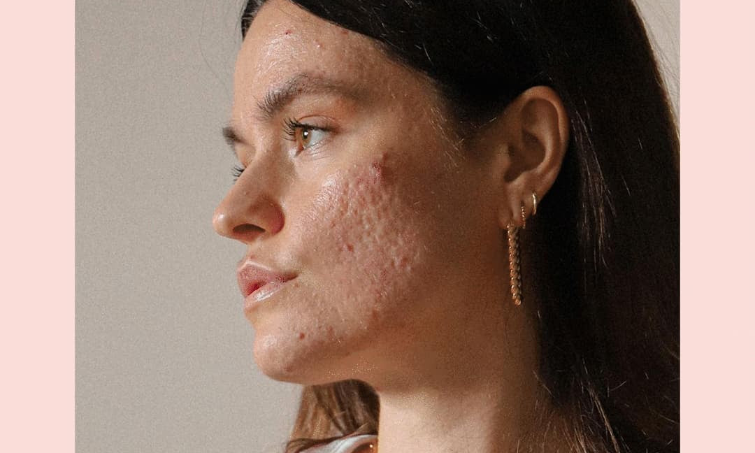 Skin Positivity | Tudo sobre o movimento de aceitação da pele